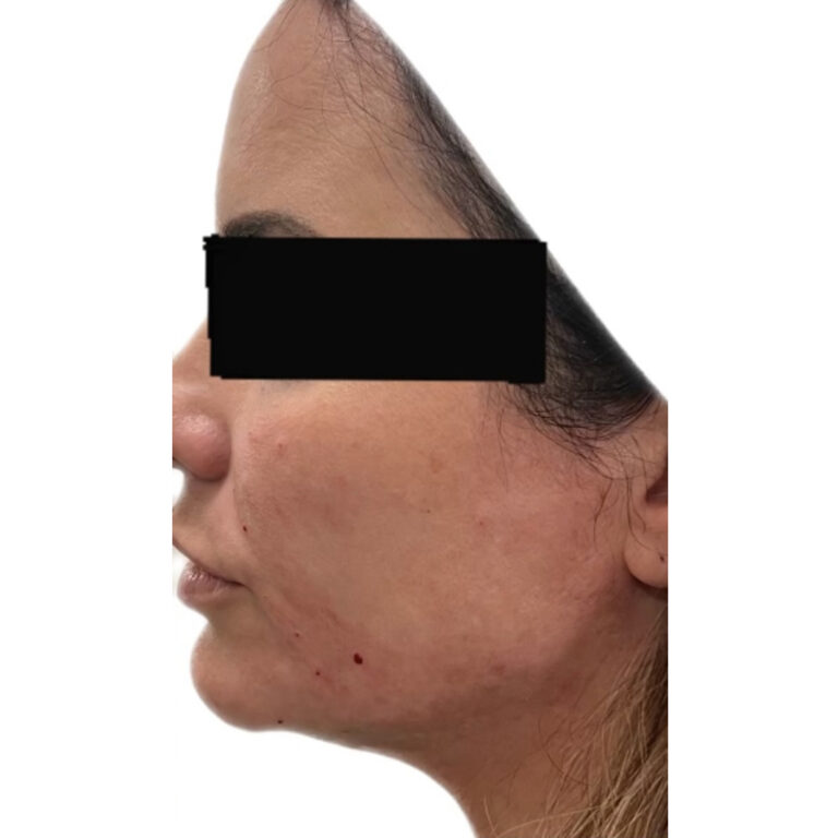 After Image: Filler - left-side
