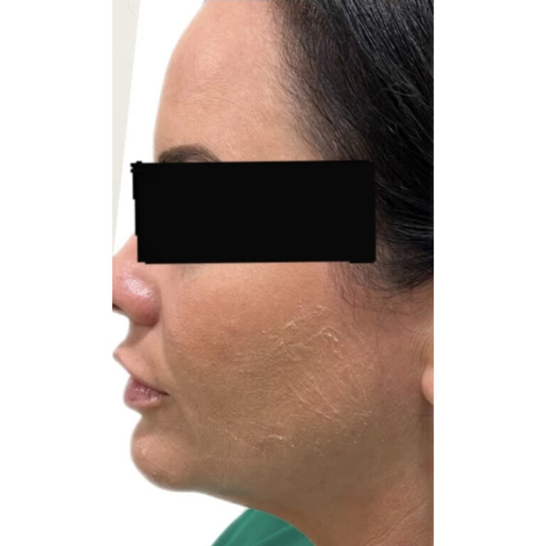 Before Image: Filler - left-side