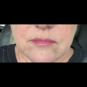 After Image: Filler