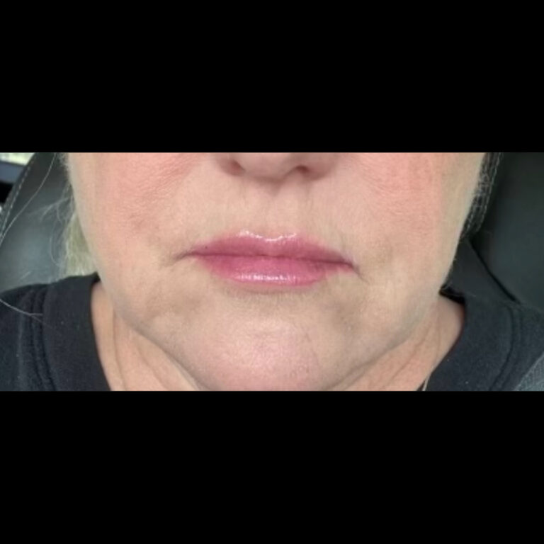After Image: Filler - front