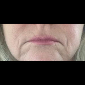 Before Image: Filler