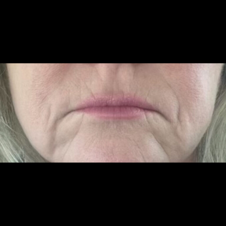 Before Image: Filler - front