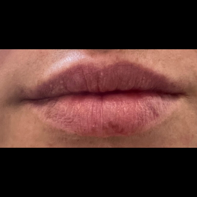 Before Image: Lips - front