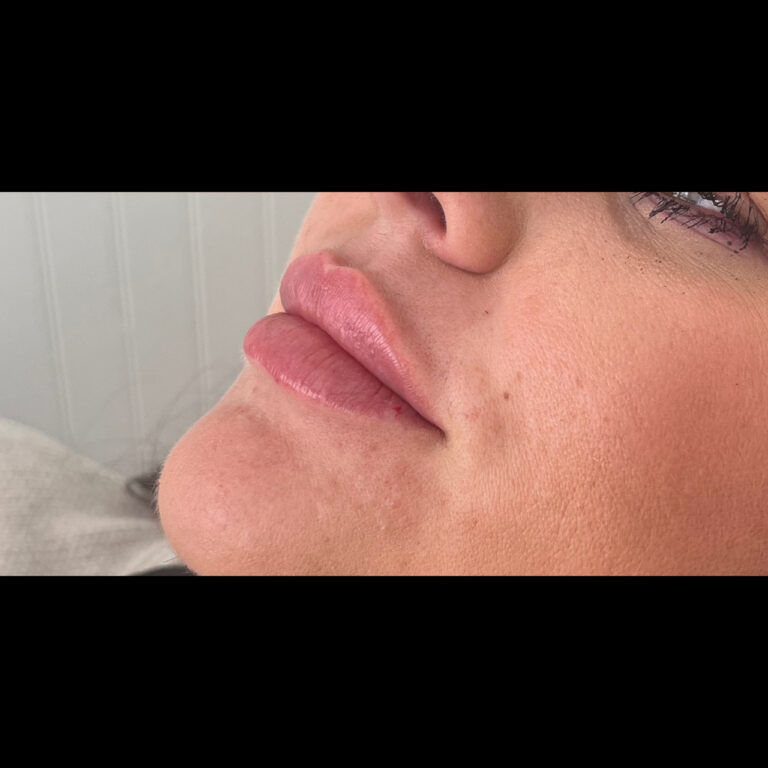 After Image: Lips - left-front-oblique