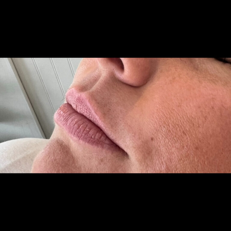 Before Image: Lips - left-front-oblique