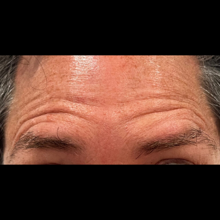 Before Image: Neurotoxins - front